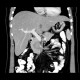 Solid pseudopapillary tumor of pancreas: CT - Computed tomography